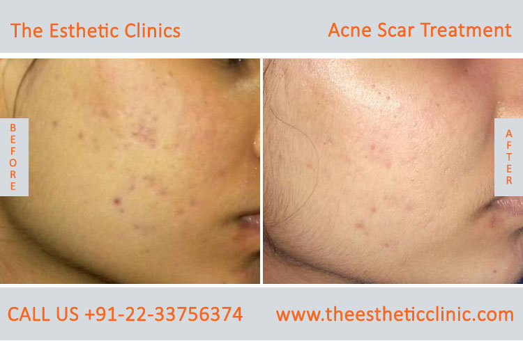 face acne scars removal laser treatment before after photos in mumbai india (5)